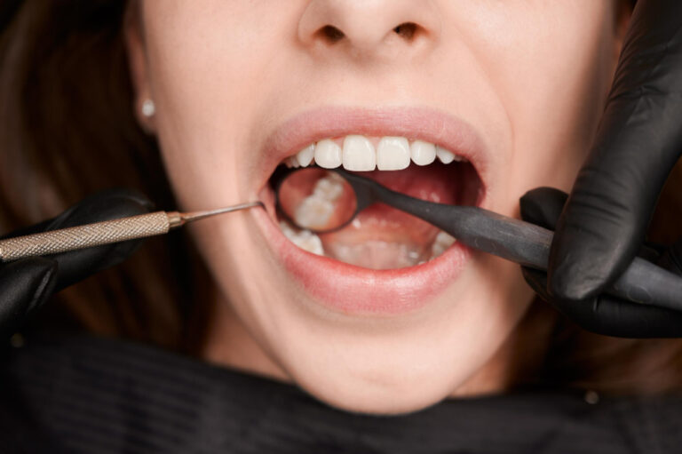 Close-up of a dental examination inside a patient's mouth.